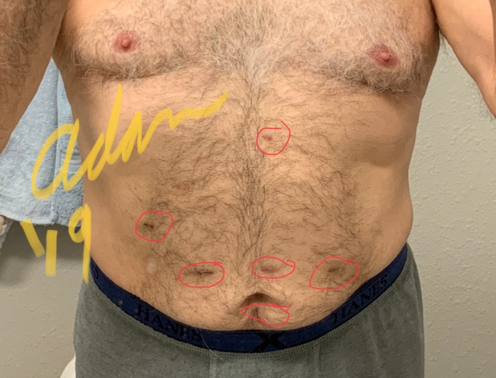 Adan’s Laparoscopic scars from 2 surgeries