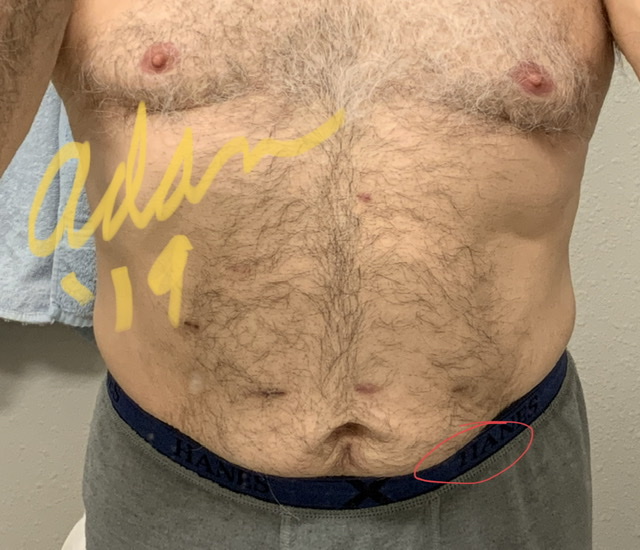 Adan’s unseen laparoscopic scar location