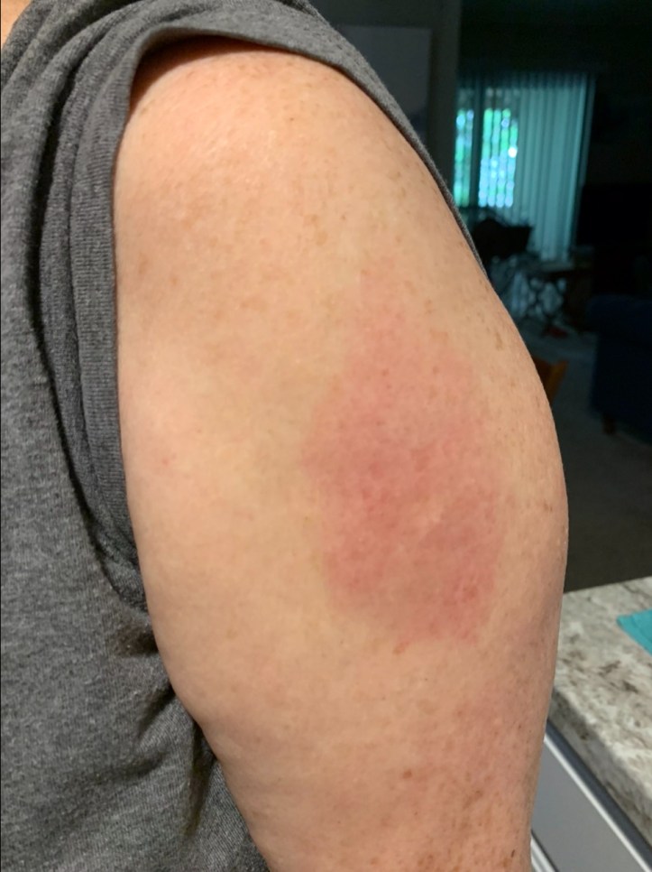 Sheila's Covid arm after Booster shot Aug 2021 @Felipe Adan Lerma