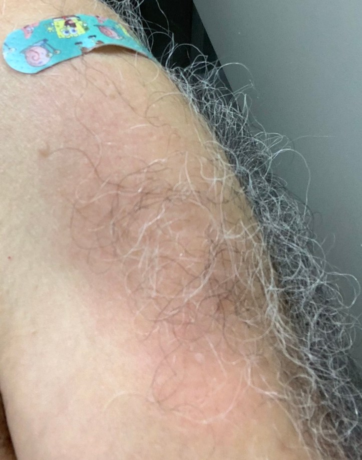 Adan's Covid arm after Booster shot Aug 2021 ©Felipe Adan Lerma